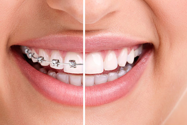 Where to get your braces treatments in London?